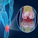 Úloha kolagénových derivátov v liečbe osteoartrózy a regenerácii kĺbovej chrupavky: systematický prehľad